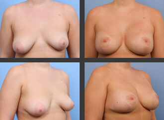 Breast asymmetry correction before and after 01, Brisbane Plastic Surgeon, Dr Broadhurst